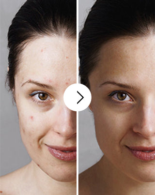 Akne, bumser og ujævnheder - tabletter med zink, C-, E- og B2-vitamin Derminax_3 - 3