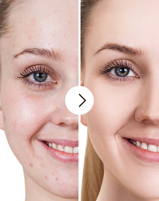 Akne, bumser og ujævnheder - tabletter med zink, C-, E- og B2-vitamin Derminax_5 - 5