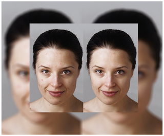 Akne, bumser og ujævnheder - tabletter med zink, C-, E- og B2-vitamin Derminax