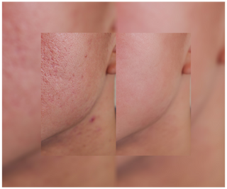 Akne, bumser og ujævnheder - tabletter med zink, C-, E- og B2-vitamin Derminax