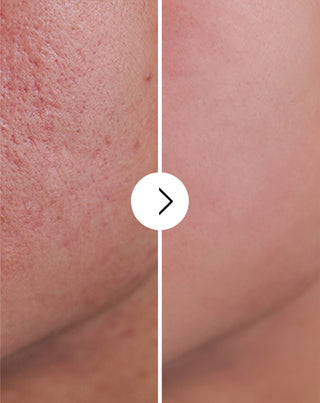 Akne, bumser og ujævnheder - tabletter med zink, C-, E- og B2-vitamin Derminax_4 - 4