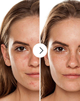 Akne, bumser og ujævnheder - tabletter med zink, C-, E- og B2-vitamin Derminax_2 - 2